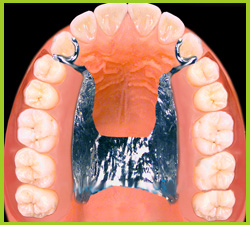 Kombinierter Zahnersatz mit Präzisionsverankerung 4.