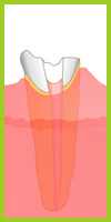 Abgebrochener Zahn mit Wurzelbehandlung